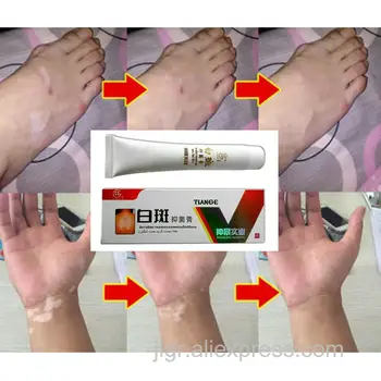 Vitiligo Leukoplakia Sygdom, Behandling Salve Hvid Plet Sygdom Repair Cream Kinesisk Medicinsk Pigment Melanin Skin Care Balm